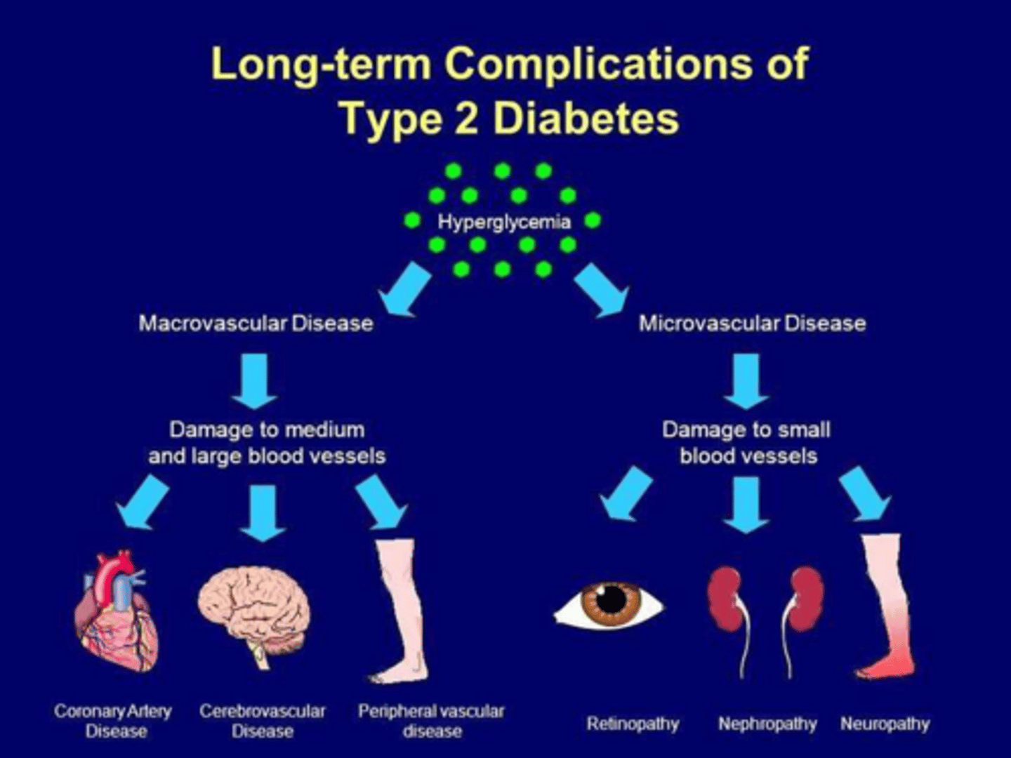<p>Insulin resistance combined with progressive loss of beta cell insulin secretion.</p>