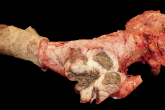 <p>Tarsus from a dairy cow </p><ol><li><p>Pathologic process</p></li><li><p>Acute or chronic </p></li><li><p>Benefits of the reaction </p></li><li><p>Harm of the reaction </p></li></ol>
