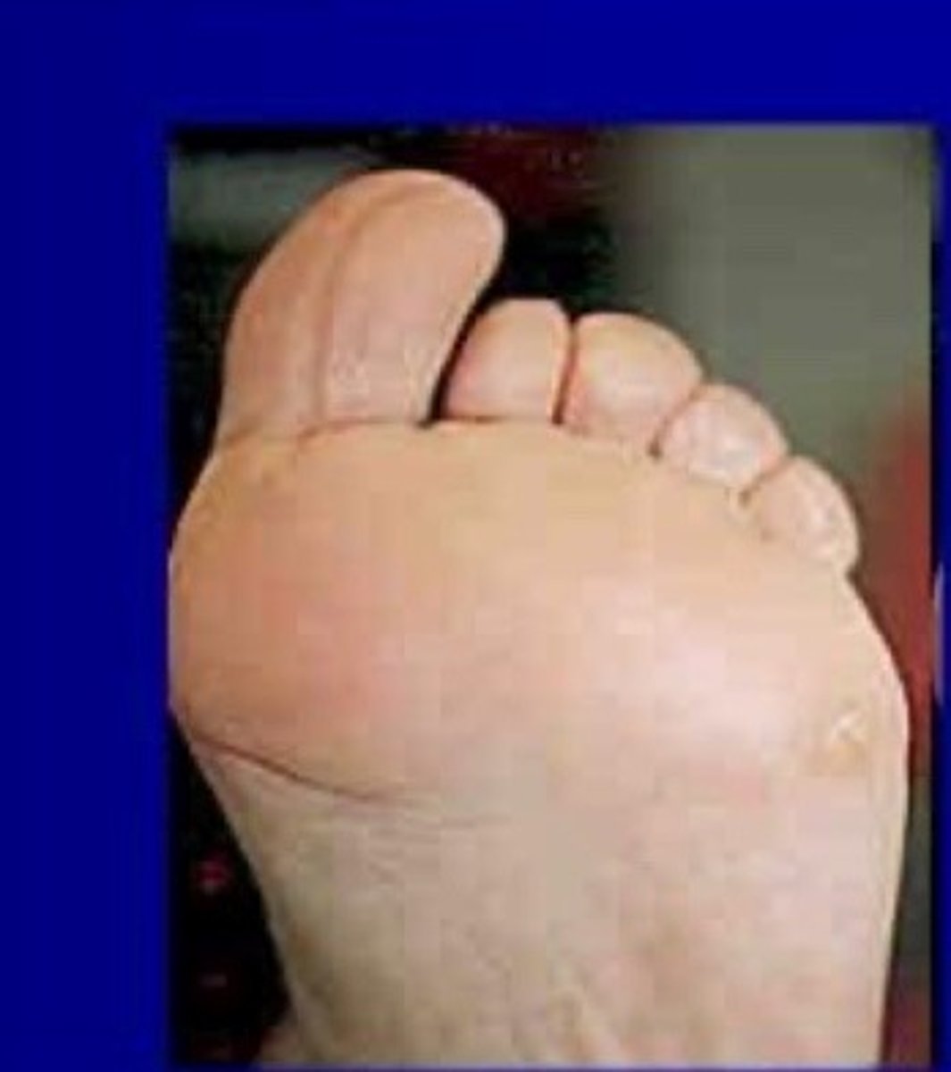 <p>Wagner grade ___ diabetic wounds; no open lesions, may have deformities or cellulitis, damage to foot but skin is intact, may have pre-ulcer lesions, bone deformities</p><p>Treatment = protection</p>