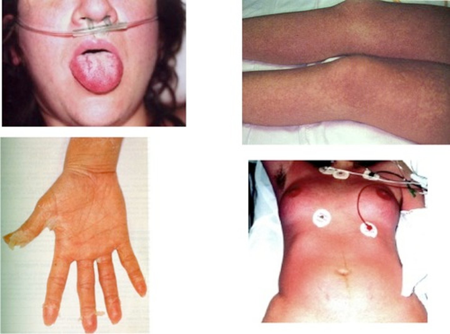 <p>acts as superantigen to induce overreactive immune responses that cause toxic shock syndrome</p>