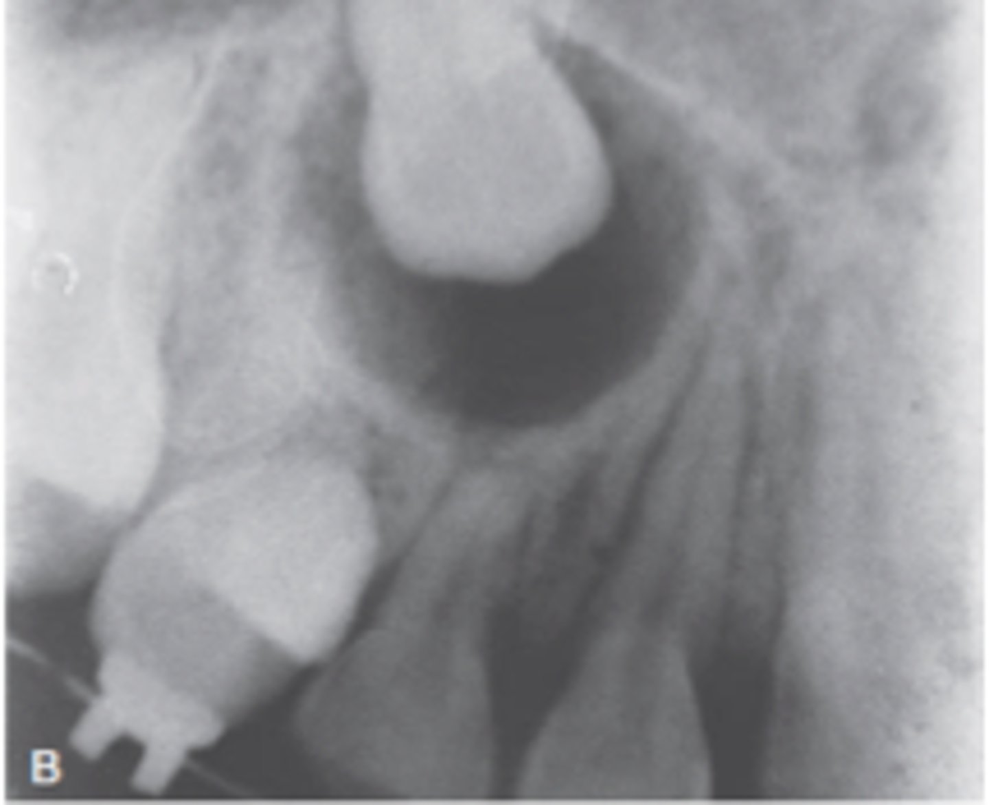 <p>1) maxilla</p><p>2) anterior (80%)</p><p>3) associated with impacted tooth (75%)</p>