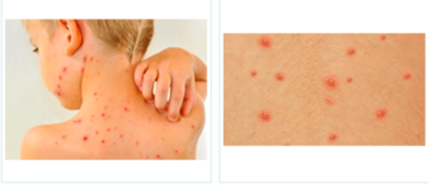 <p>Viral Skin Infections:</p><p>If a pt presented w the following S/S, what may we suspect they have:</p><p>- mild prodrome in children</p><p>-<strong> papules --&gt; vesicles --&gt; pustules --&gt; crusts --&gt; scars (seeing all stages of evolution simultaneously)</strong></p><p>- dew drop on rose petal = vesicle on red base</p><p>- started on face &amp; scalp; then spread inferiorly and focus on trunk</p>