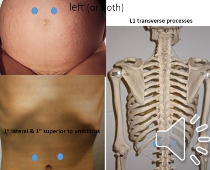 <p>anterior point: 1" lateral and 1" superior to umbilicus<br>posterior point: L1 transverse process</p>