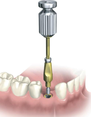 <p>What will NOT come out in the impression in the closed tray impression technique?</p>