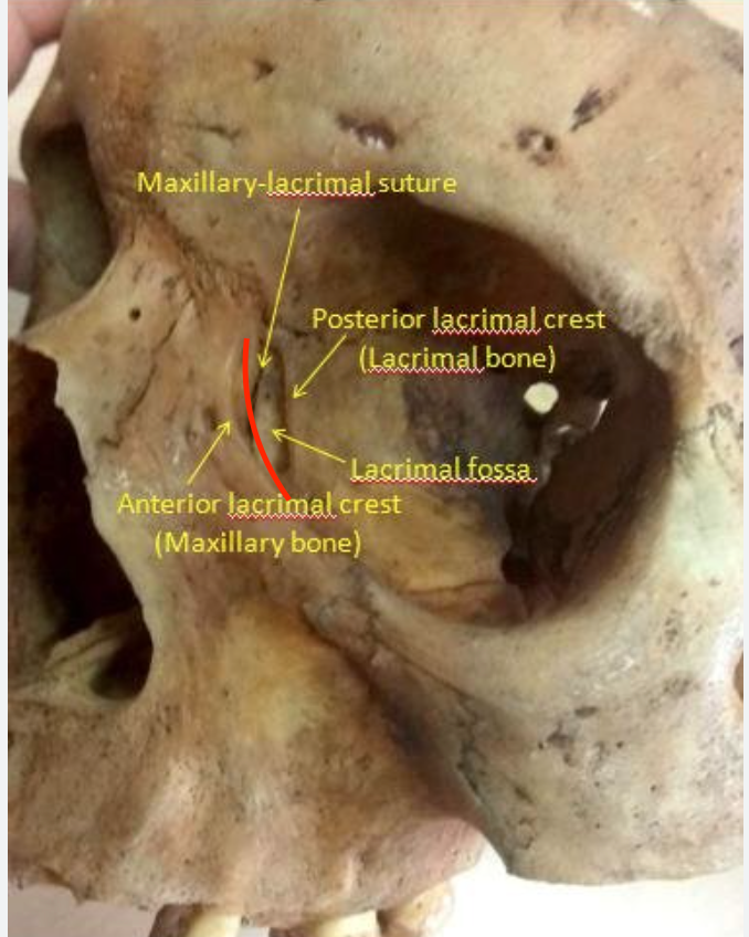 <p>ridge that makes up the front of lacrimal fossa on maxilla</p>