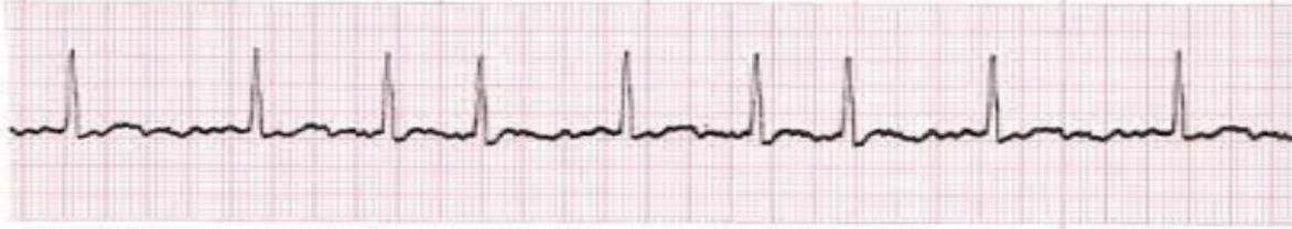 <p>no P waves; irregularly irregular, HR usually &gt; 100; </p>