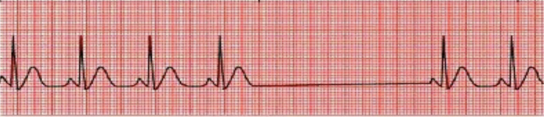<p>absence of cardiac cycles(s); P-P intervals will not march out across rhythm strip due to SA node restarting</p>