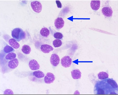 <p>After suspecting that his patient may have lung disease, the physician sends a bronchoalveolar lavage (BAL) to the laboratory for examination. What is the cell type noted by the arrows in this cytospin sample?</p><p>Lymphocytes</p><p>Mesothelial cells</p><p>Macrophages</p><p>Bronchial lining cells</p>