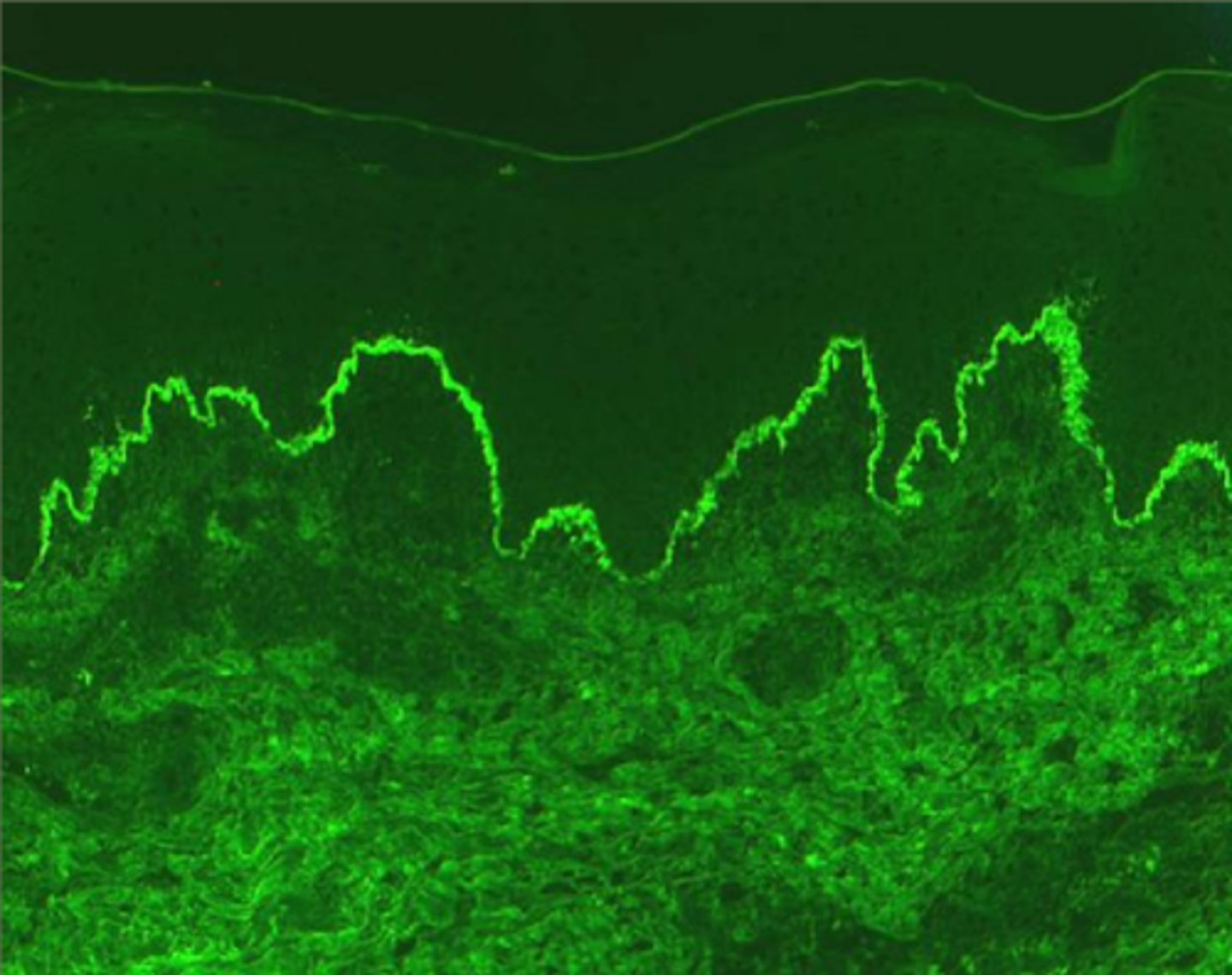 <p>which pemphigus?</p>