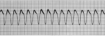 <p><span><span>Can be sustained or nonsustained</span></span></p><p style="text-align: left;"></p><p style="text-align: left;"><span><span>Sustained = Emergency</span></span></p>