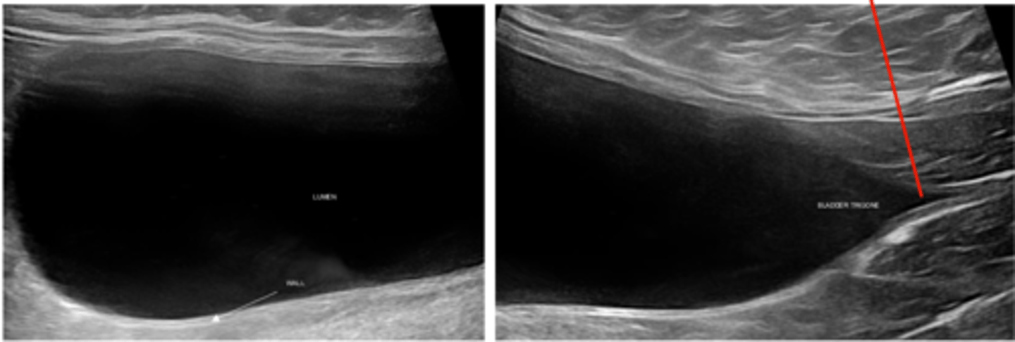 <p>Anechoic</p><p>Wall thickness &lt;2 mm</p><p>urethra at the edge of the bladder trigone</p>