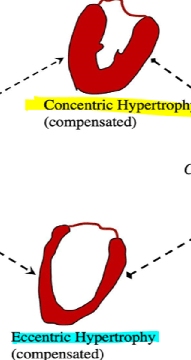 <p>A healthy heart encounters chronic pressure-overload. The heart undergoes [concentric/eccentric] hypertrophy in order to compensate. What are some examples that would cause pressure overload in the heart?</p>