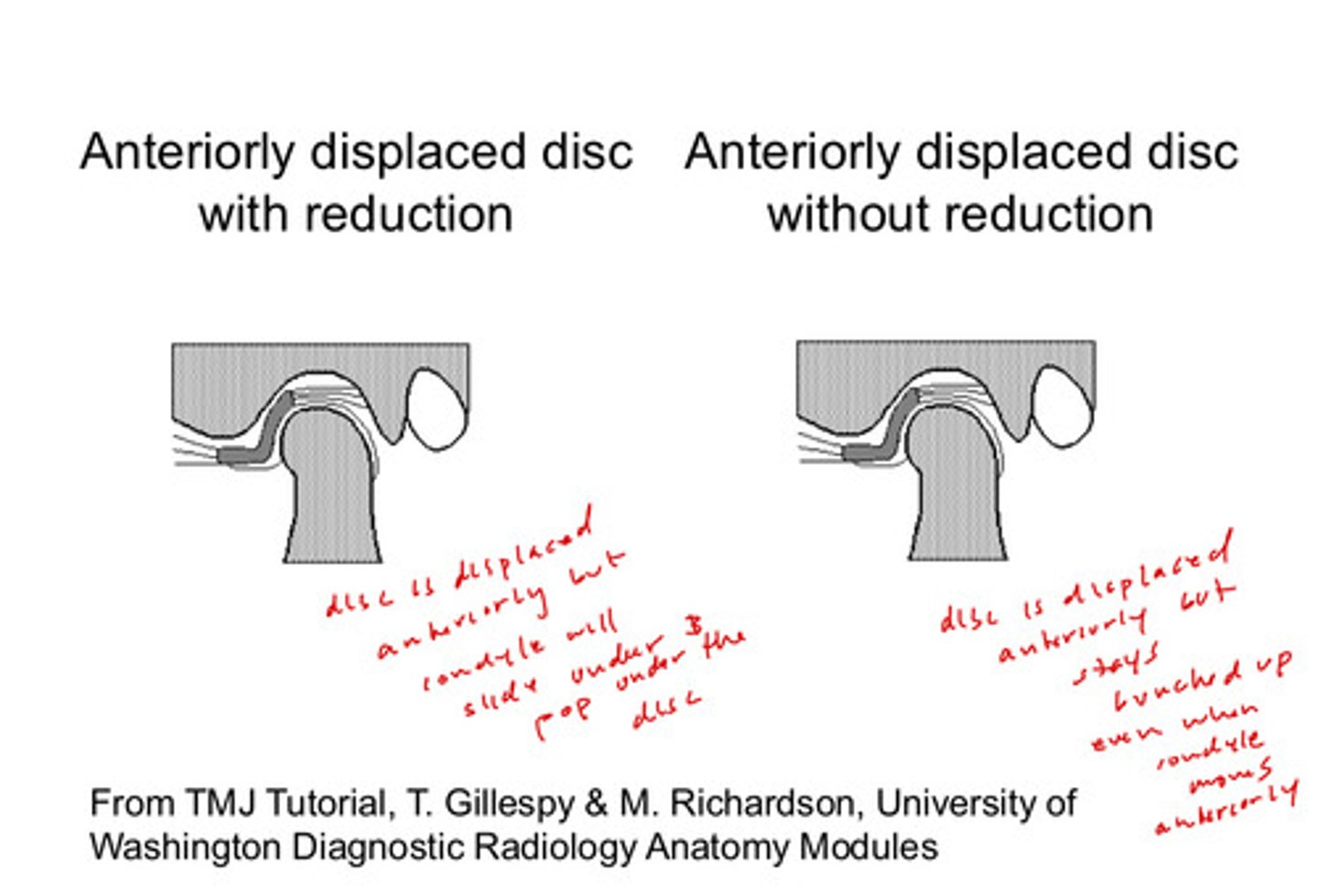 <p>with reduction: the disc is displaced anteriorly but the condyle will slide under it during opening and pop under the disc</p><p>without reduction: the disc is displaced anteriorly but the disc stays bunched up even when the condyle moves anteriorly</p>