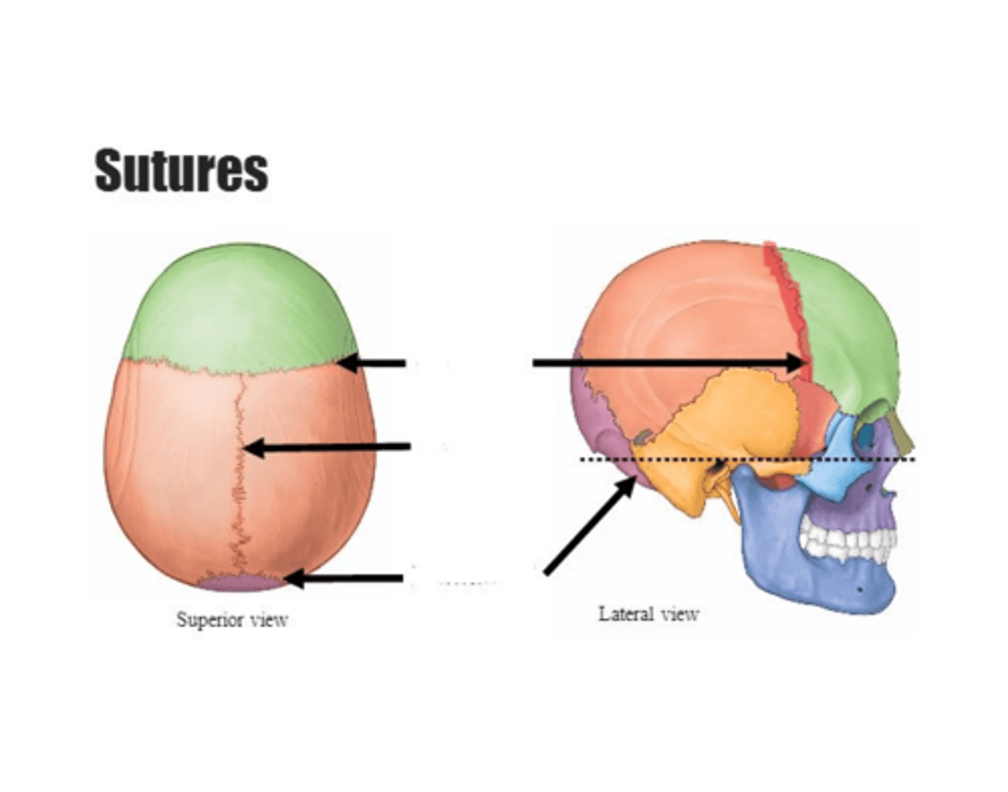 <p>Coronal suture</p>