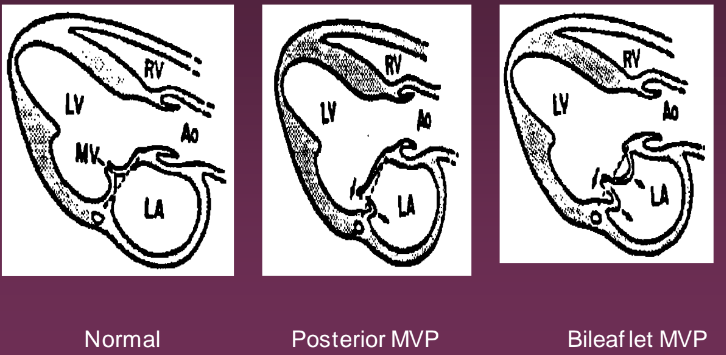 <ul><li><p>Any portion of the AMVL or PMVL leaflets prolapse beyond an imaginary line drawn from the post aortic wall to the AV groove (MV annulus) into LA during systole</p></li><li><p>Myxomatous (AKA redundant) appearance to the MV leaflets</p></li></ul>
