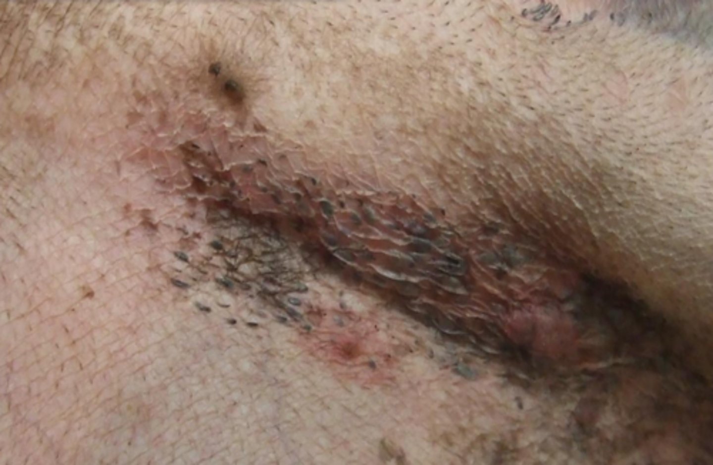 <p>What lesion is this? Is it primary or secondary?</p>