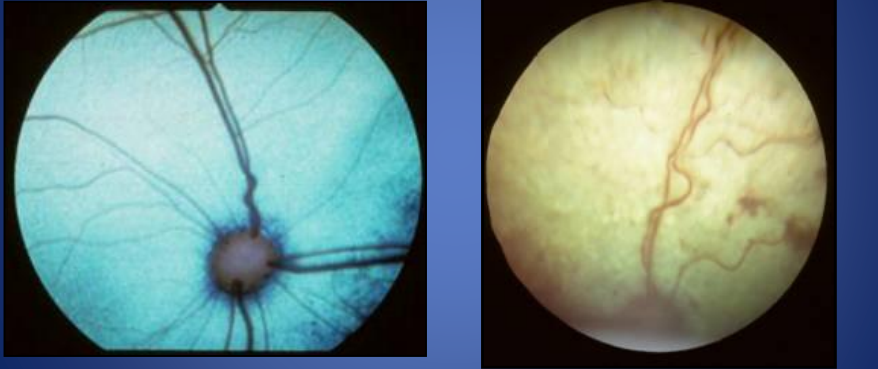 <p>which fundic exam is hypertensive </p>