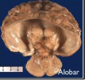 <p>cephalic disorder in which the embryo forebrain fails to develop into two hemispheres</p>