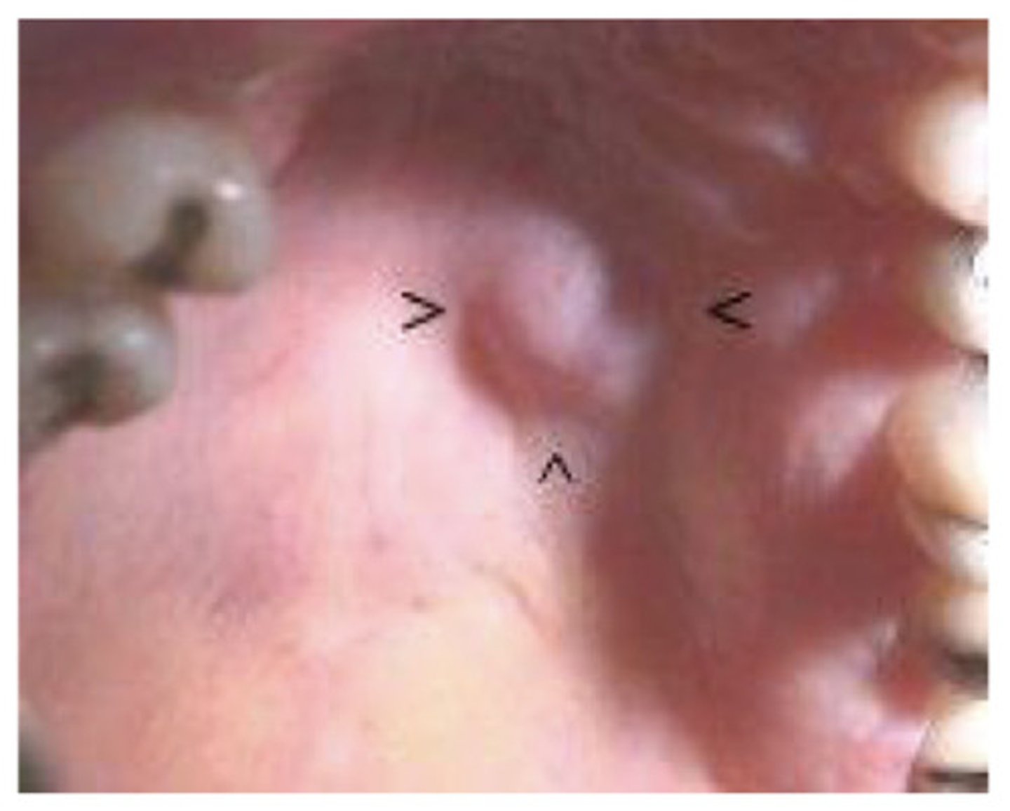 <p>A benign tumor of glandular origin - usually lobulated firm or rubbery and can be pleomorphic or monomorphic</p>
