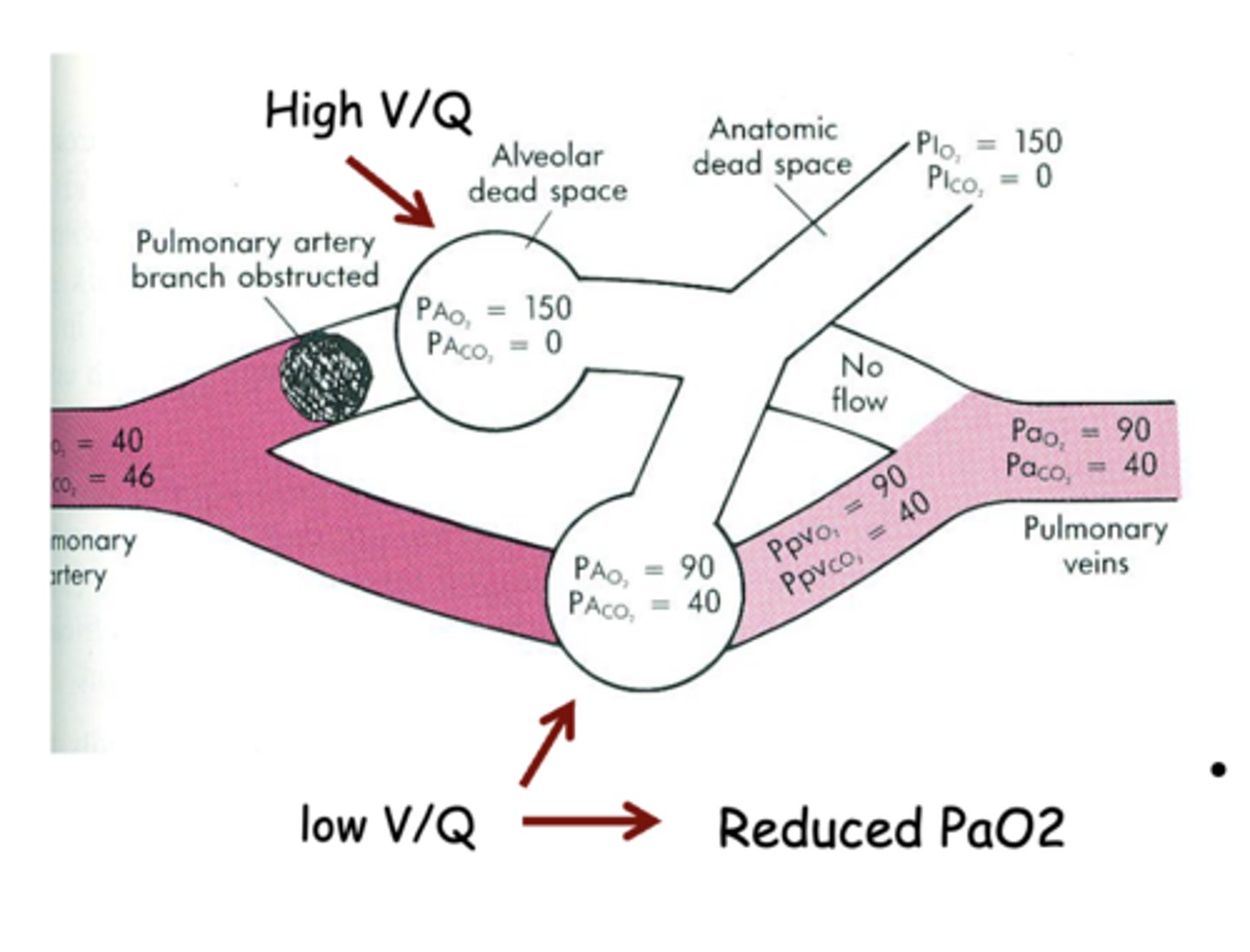 <p>number of alveoli affected by the loss of perfusion</p>