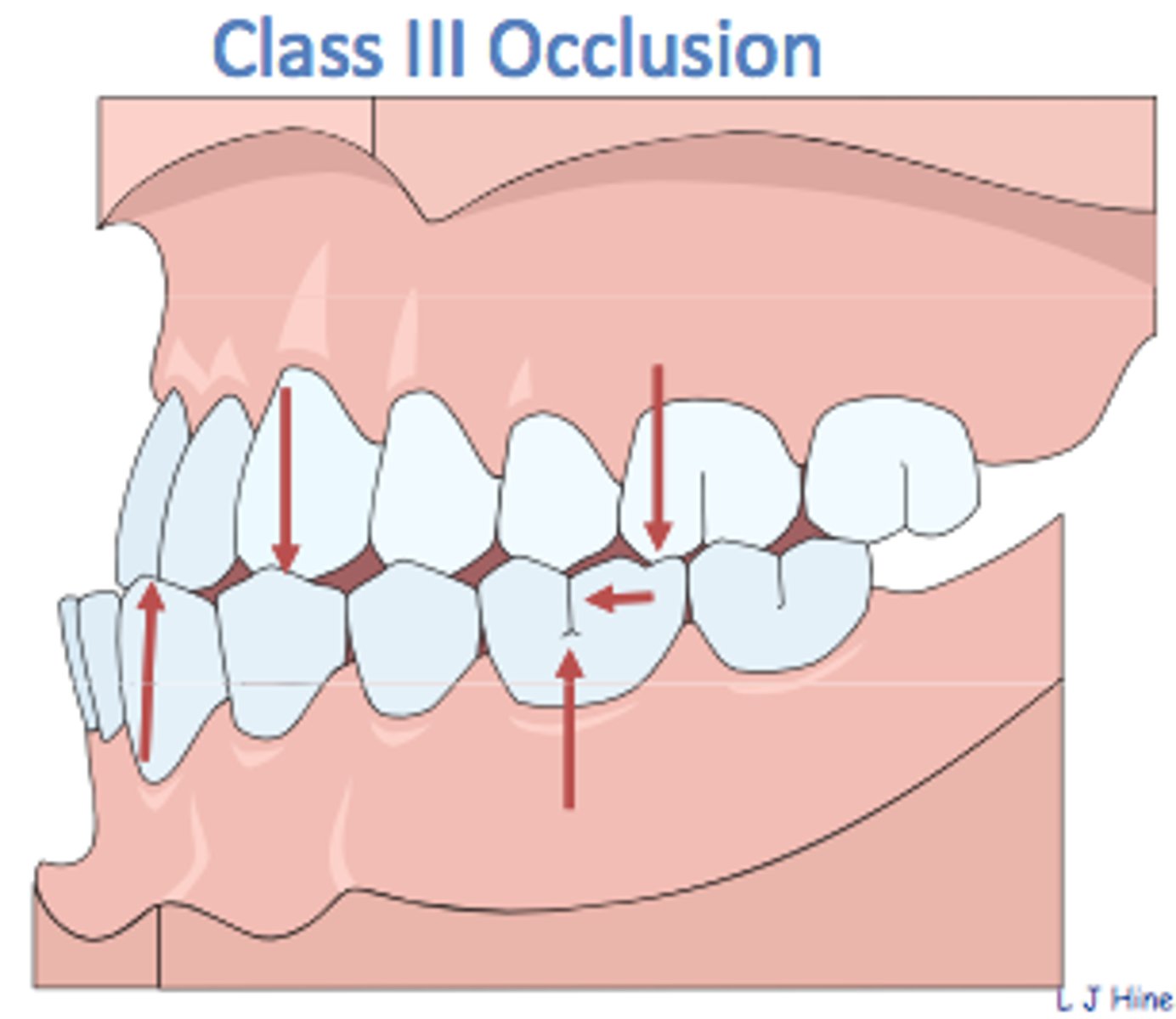 <p>3=P (Prognathic)</p><p>Molar Relationship: Buccal groove of the mandibular first permanent molar is mesial to the mesiobuccal cusp of the maxillary first permanent molar by at least the width of a premolar</p><p>Canine Relationship: Mesial portion of the maxillary canine is distal to the distal surface of the mandibular canine by the width of a premolar</p>