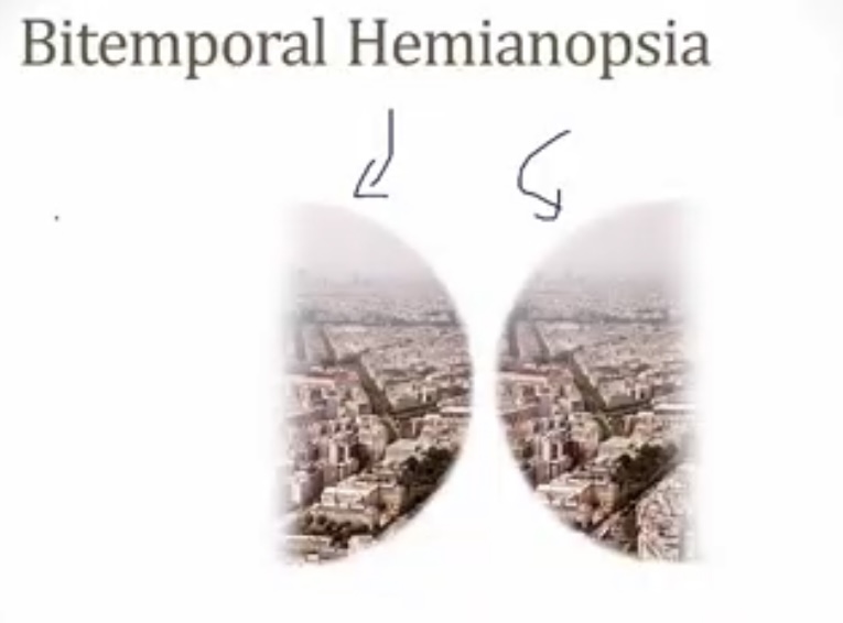 <p>-vision loss of the lateral field of both eyes</p><p>-optic chiasm compression; pituitary tumor</p>