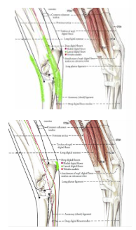 <ol><li><p>tendon sheaths - ease passage of tendons around angles</p></li><li><p>bursae - cushion and protect soft tissues passing over hard ‘points'</p></li></ol><p></p>