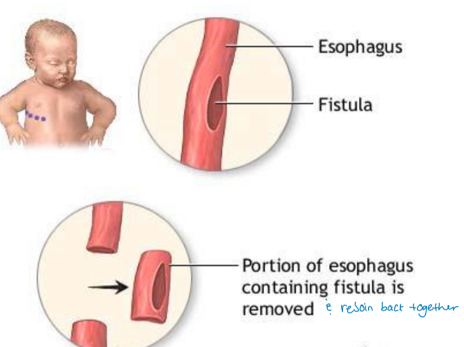 <ul><li><p>First feeding after surgery should be sterile water</p><ul><li><p>If the suture isn’t correct only water will go into body</p><ul><li><p>No formula/breast milk in case surgery is unsuccessful </p></li></ul></li></ul></li></ul>