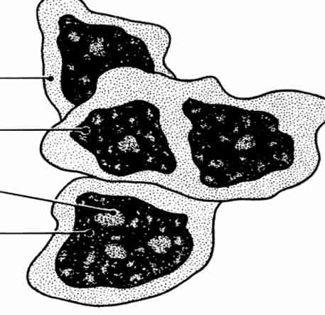 <p>Small cytoplasm, multiple nuclei and large nucleolus,  coarse chromatin</p>
