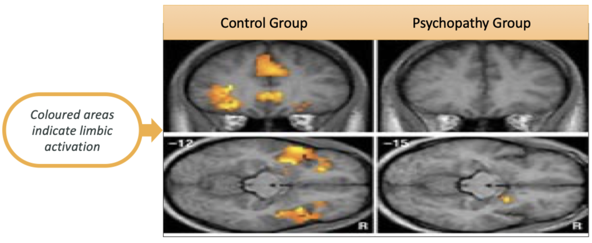 <p>decreased limbic activation when viewing violent images for those high in psychopathy vs. a control group (who had more activity)</p>