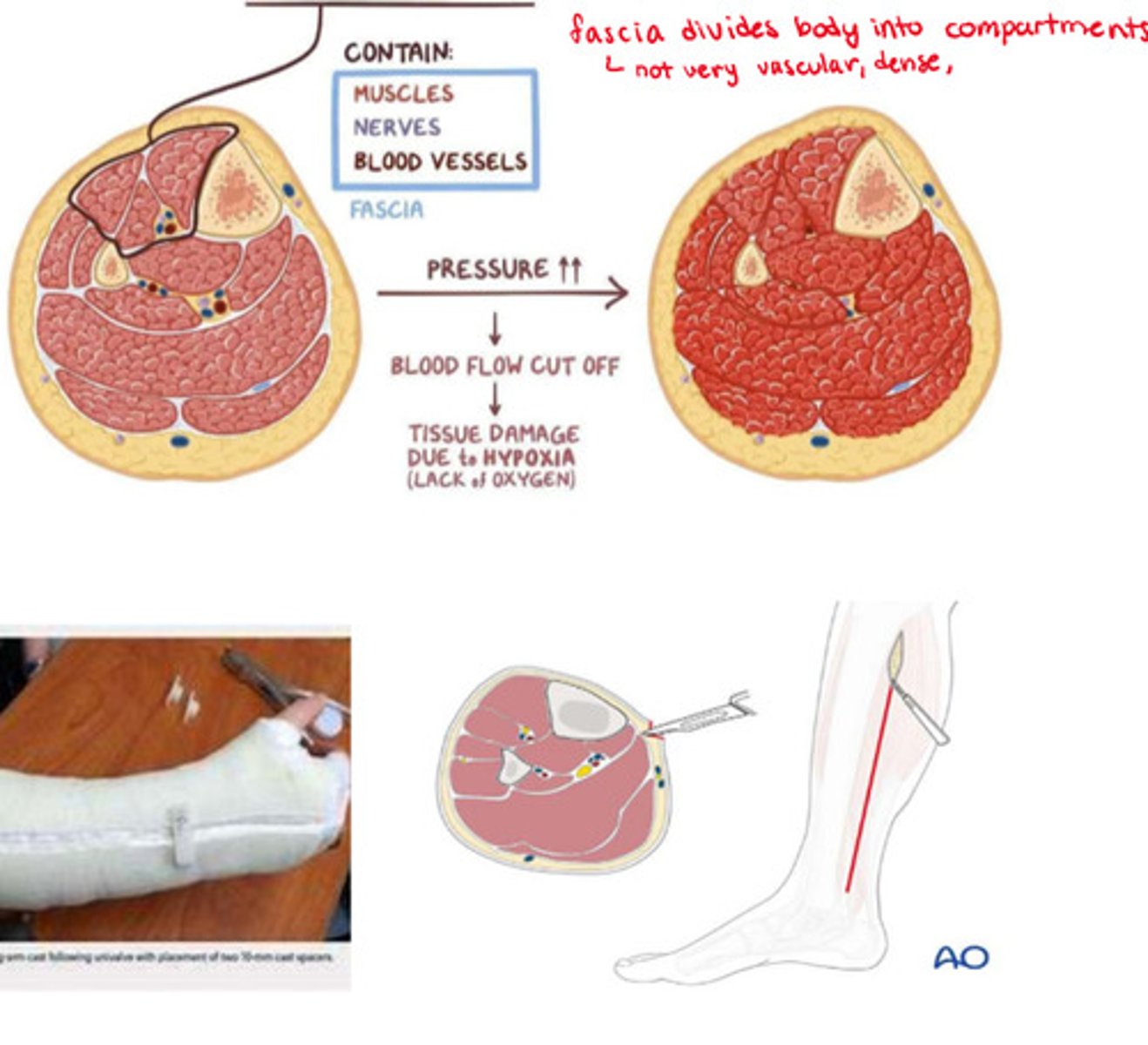 <p>- high pressure within a body compartment (fascia - contains muscles, nerves &amp; vessels)</p><p>- due to injury's inflammatory sequelae causing increase in volume</p><p>- emergency! risk of total loss tissue/extremity/necrosis</p><p>increased pressure => ischemia &amp; hypoxia => tissue damage</p>