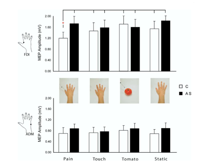 <p>Mino-Palvello et al (2008) AS &amp; empathy </p>