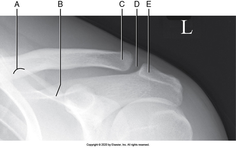 <p>Identify the labeled "D" anatomy in the image below:</p><p>AC joint</p><p></p><p>Scapular spine</p><p>&nbsp;</p><p>Superior scapular angle</p><p>&nbsp;</p><p>Lateral clavicle</p>