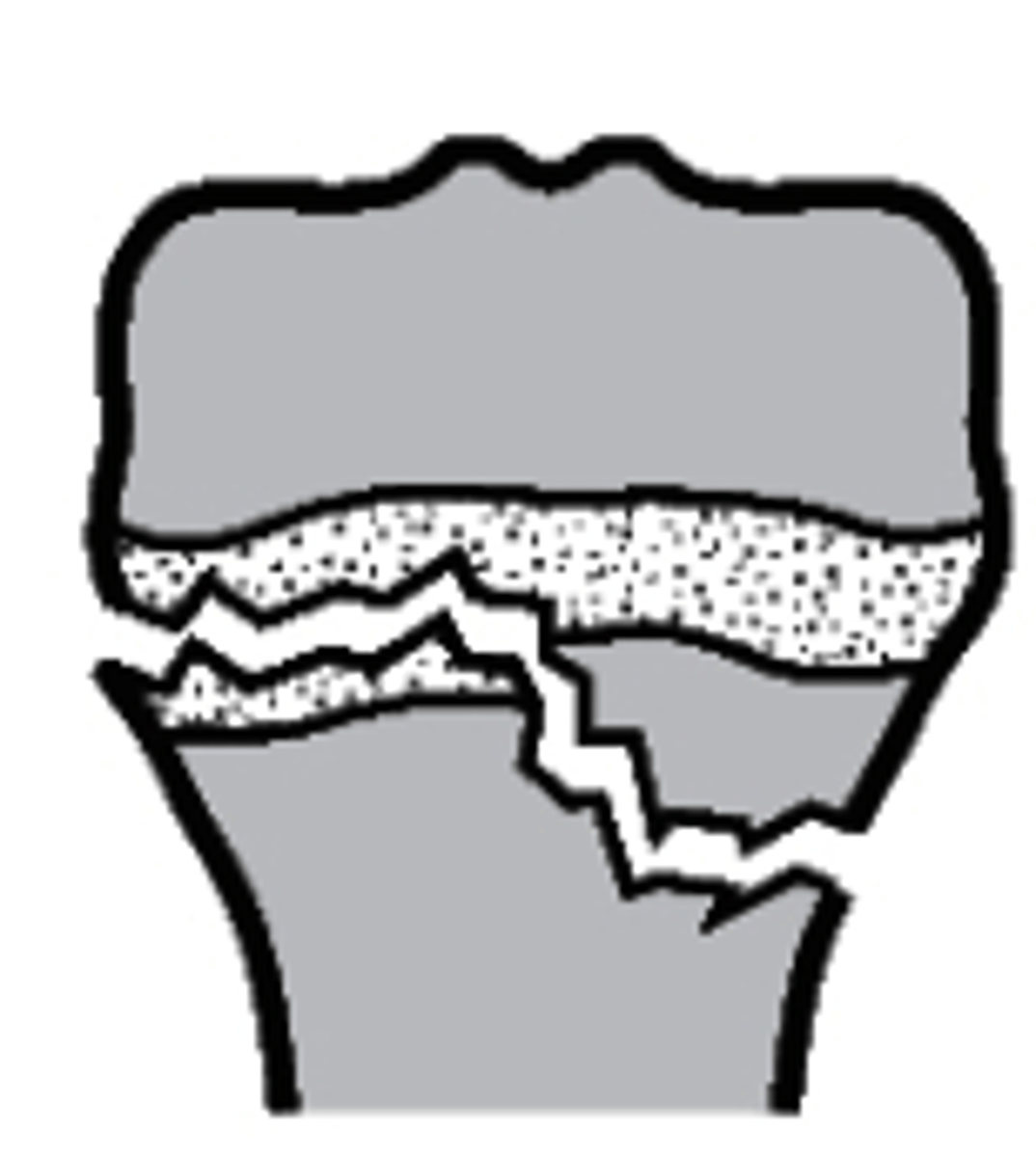 <p>what type of Salter-Harris fracture is this?</p><p>a. Type I</p><p>b. Type III</p><p>c. Type IV</p><p>d. Type II</p>
