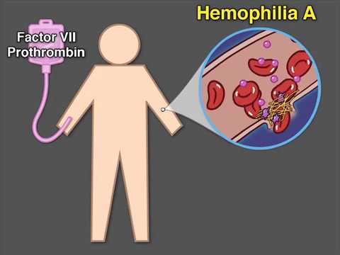 <p>Coagulation Disorders:<strong> Hemophilia A</strong></p>