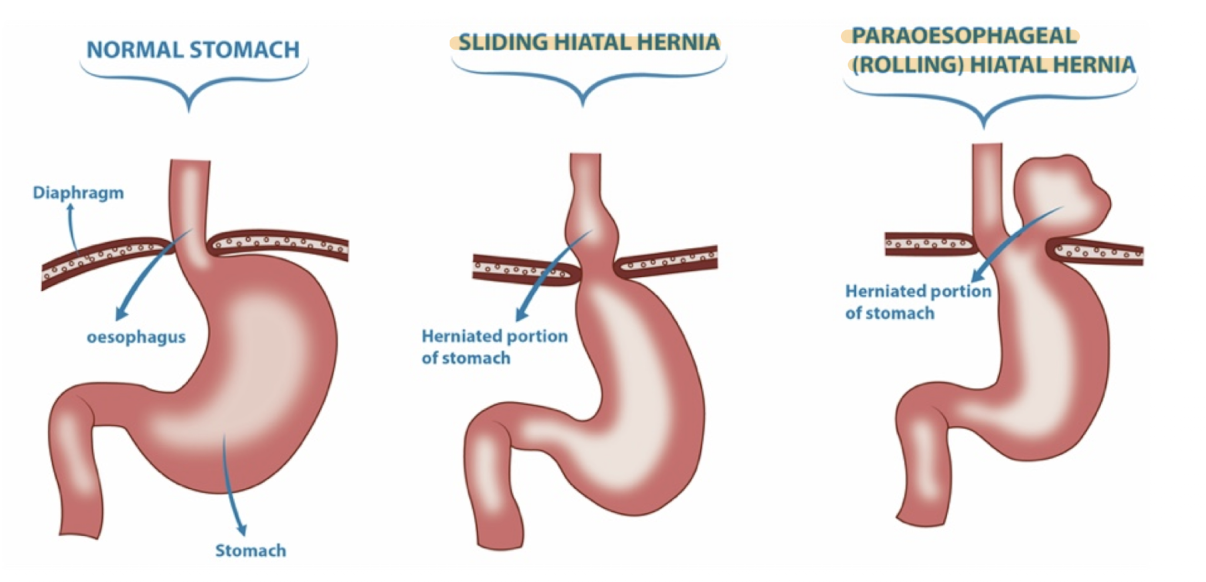 <ul><li><p>A hernia is a condition where an organ or tissue protrudes through a weak spot in the muscle or connective tissue that surrounds it</p></li><li><p>HH: part of the stomach protrudes into the thoracic cavity</p></li></ul><p></p>