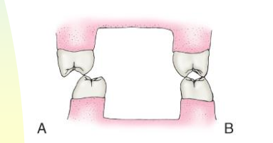 <p>aka Lateral excursion = mandible moves left or right. </p><ul><li><p>Working side = the side the mandible moves toward; teeth are in contact </p></li><li><p>Non-working side = the opposite side; no teeth are in contact</p></li><li><p>Purpose = part of normal mastication (chewing movements).</p></li></ul><p></p>