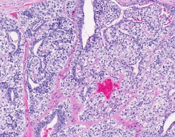 <p>Patient de 60 ans avec lésion de la parotide </p><p>1) Diagnostic</p><p>2) Epidemio (localisation, age)</p><p>3) Histo</p><p>4) IHC</p><p>5) moléculaire </p>