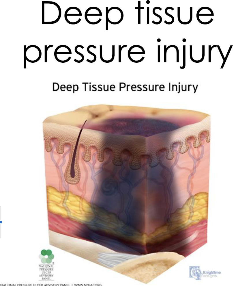 <p>Deep Tissue Injury:</p><ul><li><p>What is it?</p></li><li><p>What often precedes skin color changes?</p></li><li><p>Results from:</p></li></ul><p></p><p></p>
