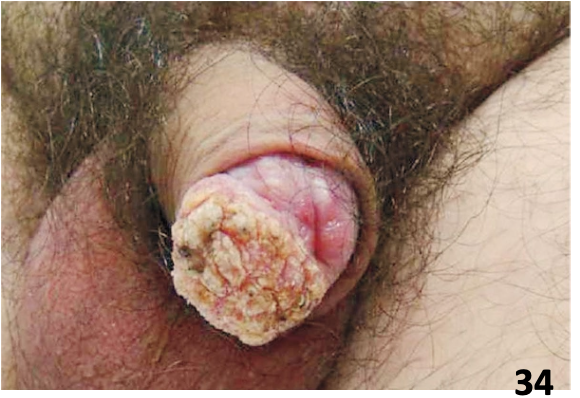 <ul><li><p><strong>Squamous cell carcinomas</strong> account for 95% of penile carcinomas</p><ul><li><p class="p2">Rare (<1% of cancers in men) in developed countries, but accounts for ~10 – 20% of cancers in Africa, Asia, and South America</p></li></ul></li></ul><p></p>