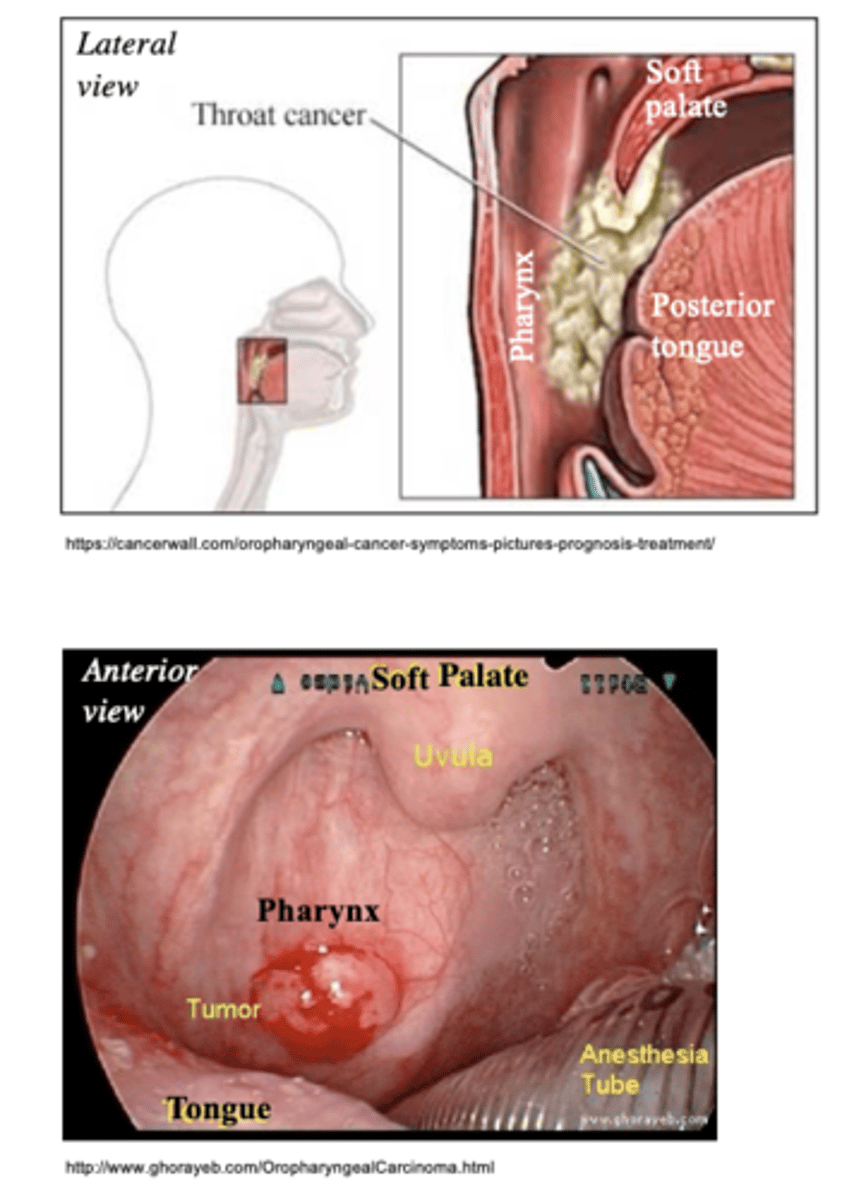<p>squamous cell carcinoma</p>