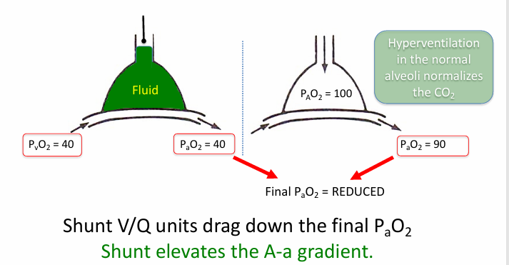 <p>-an extreme of low V/Q mismatch when V/Q = 0</p><p>-shunt: flow of deoxygenated blood that never picks up fresh O2 and is mixed back into the oxygenated blood pool</p><p>-shunt can be in heart or lungs</p>