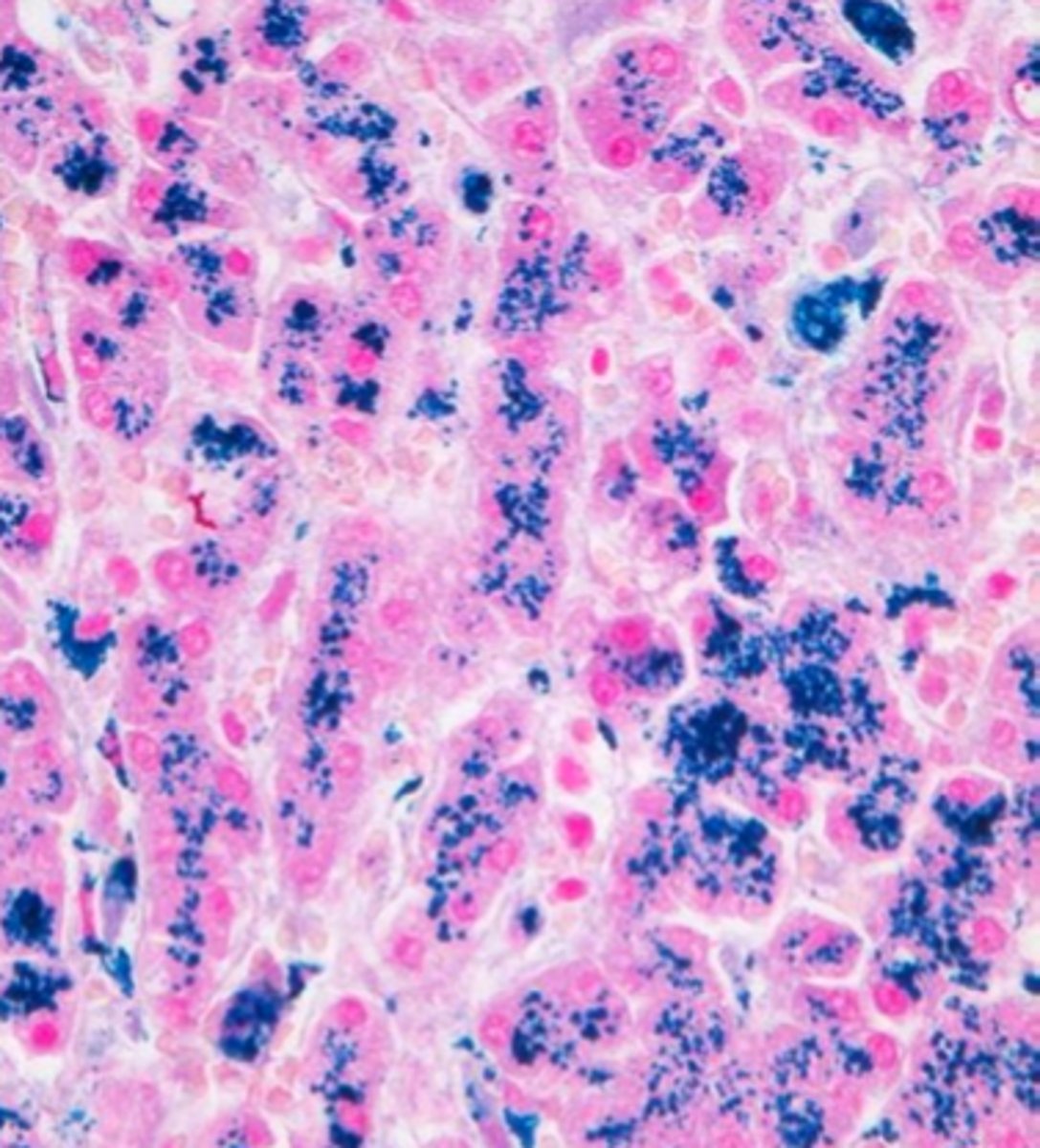 <p>In hereditary hemochromatosis, excess iron is stored in the:</p>