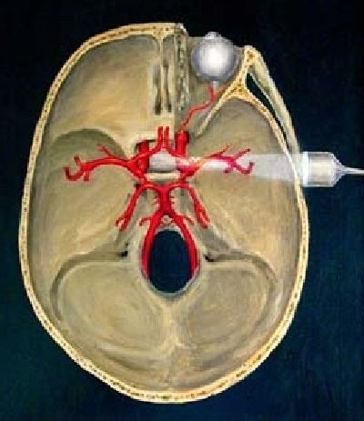 <ol><li><p>Over temporal bone </p></li><li><p>Superior to zygomatic arch</p></li></ol><p></p>