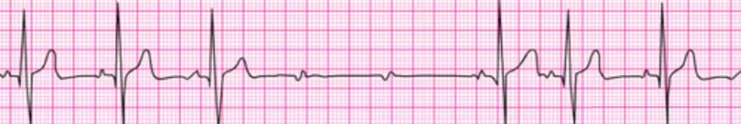 <p>Identify the rhythm.</p>