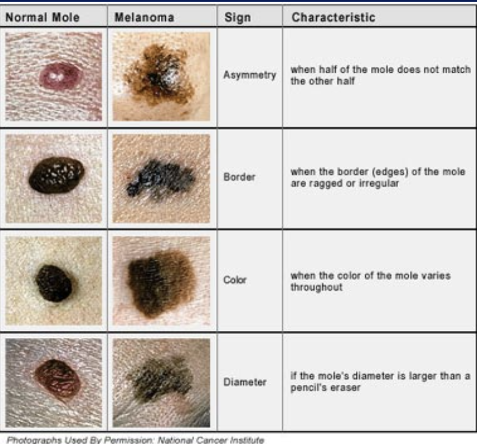 <p><span style="font-family: Google Sans, arial, sans-serif">Characteristics of skin damage that doctors look for when diagnosing and classifying melanomas</span></p>