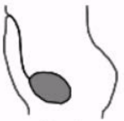 <ul><li><p>Embryonic tract formed as bladder descends into true pelvis</p></li><li><p>Usually obliterates by birth, if it doesn't it creates a channel between bladder and umbilicus</p></li></ul><p></p>