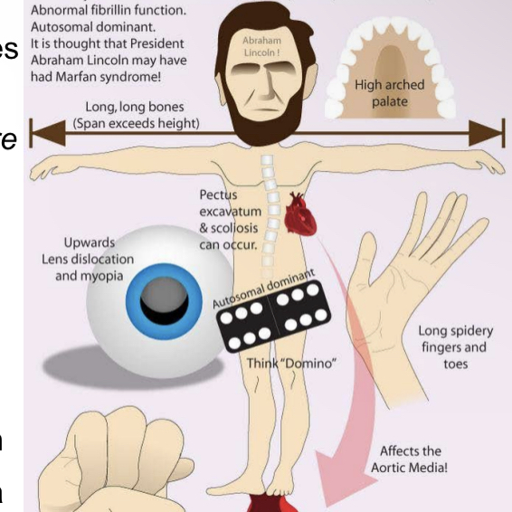 <p>Symptoms of Marfan syndrome</p>