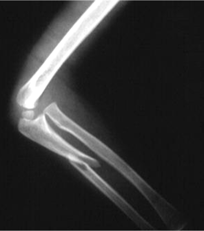 <p>fx of mid portion of ulna</p>