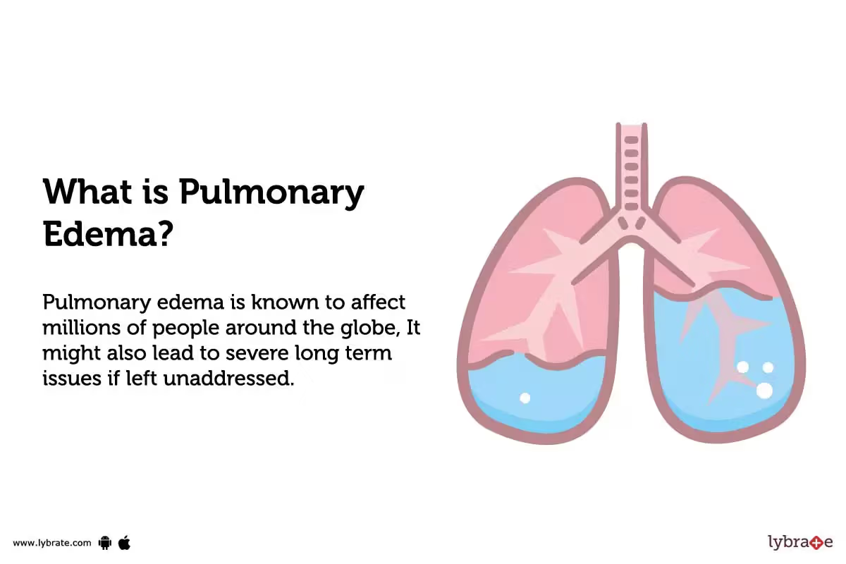 <p>Pulmonary edema</p><p><span style="color: purple"><em>(Phù phổi do tràn dịch)</em></span></p>